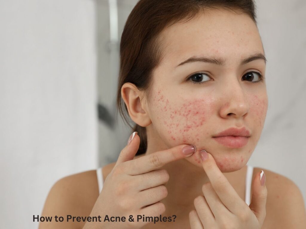 How to Prevent Acne & Pimples?
