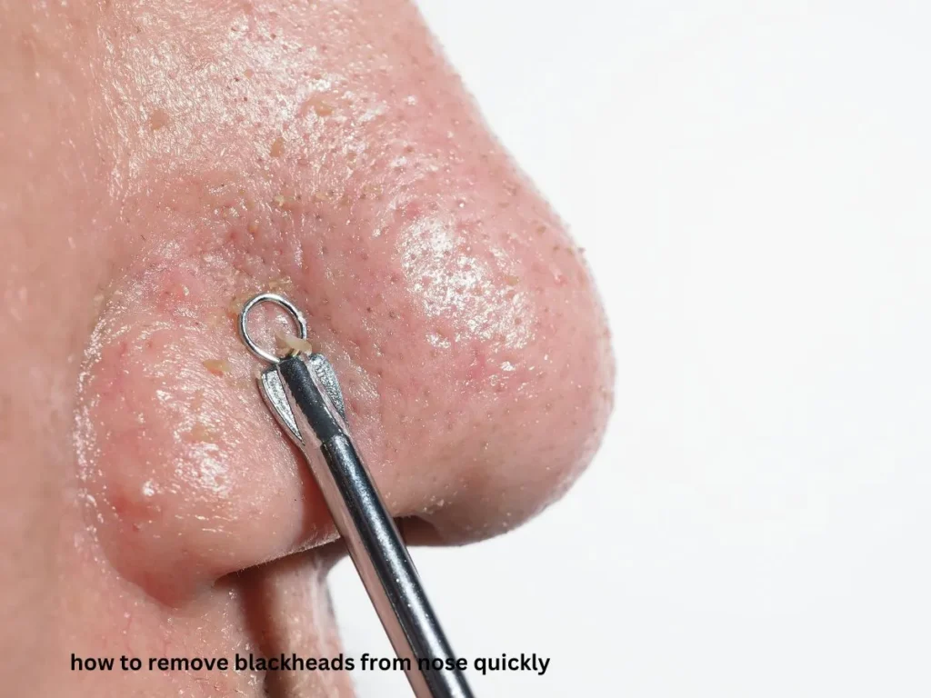 how to remove blackheads from nose quickly