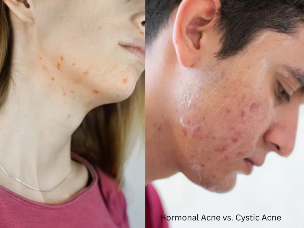 Hormonal Acne vs. Cystic Acne