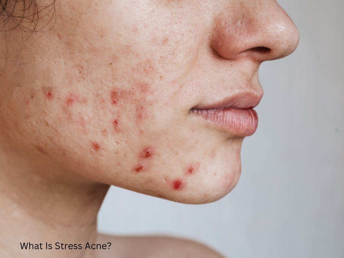 What Is Stress Acne