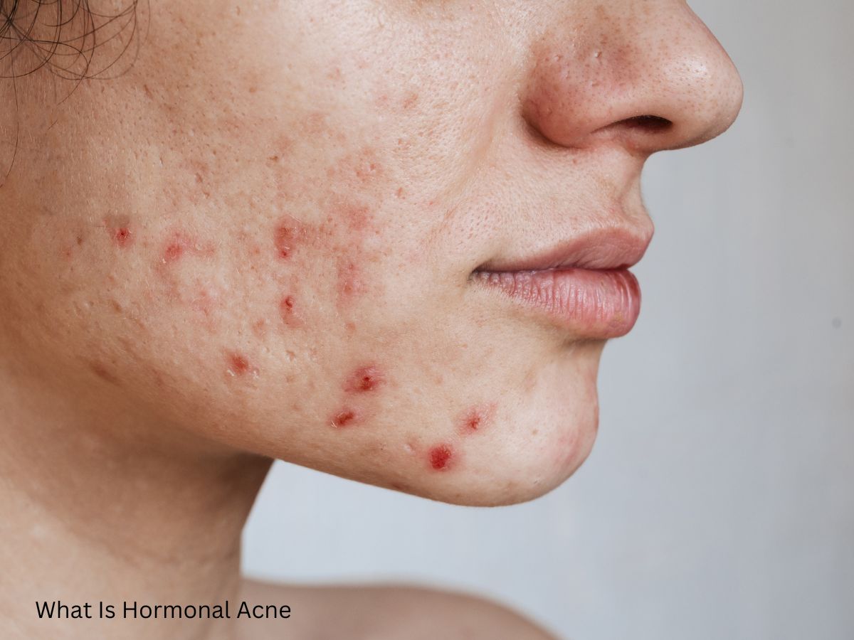 What is hormonal acne?